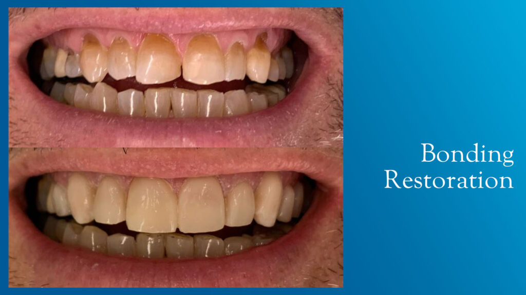 Yonge and Bloor Dental Care patient before & after