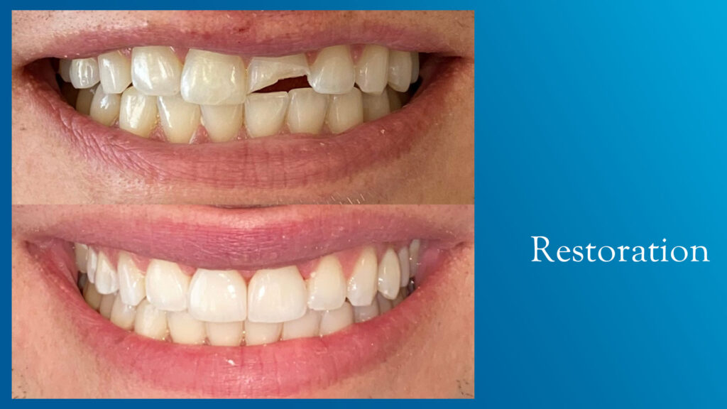 Yonge and Bloor Dental Care patient before & after