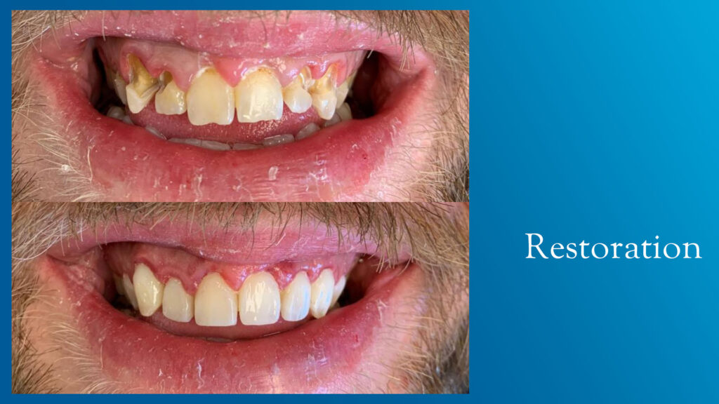 Yonge and Bloor Dental Care patient before & after