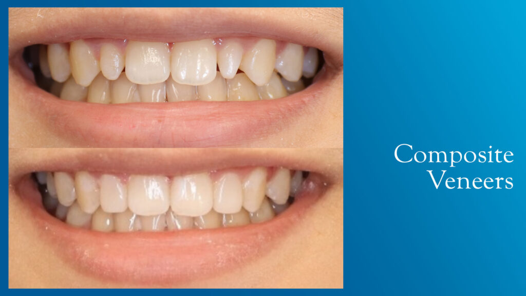 Yonge and Bloor Dental Care patient before & after