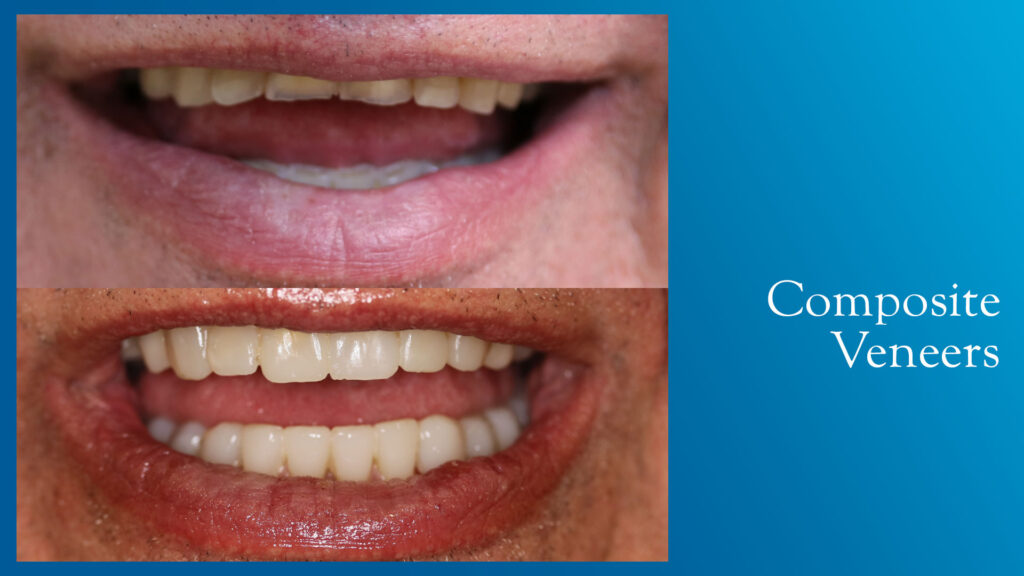 Yonge and Bloor Dental Care patient before & after