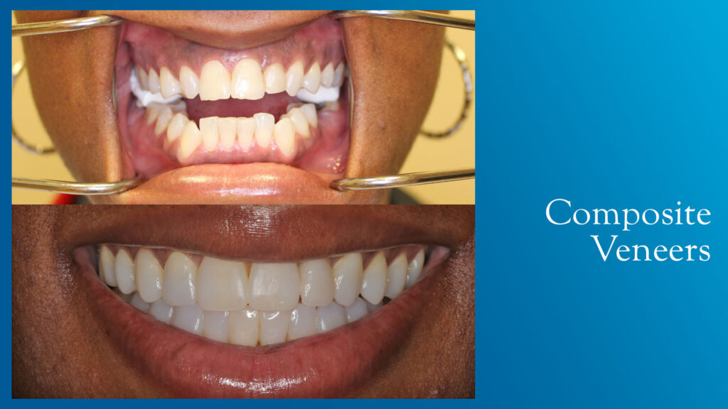 Yonge and Bloor Dental Care patient before & after