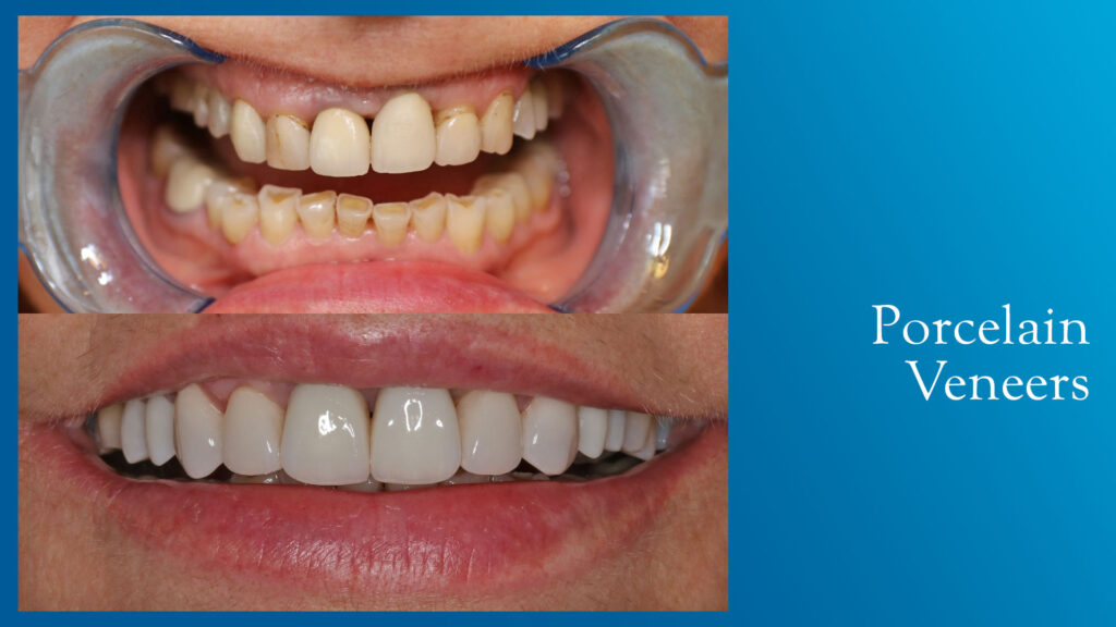 Yonge and Bloor Dental Care patient before & after