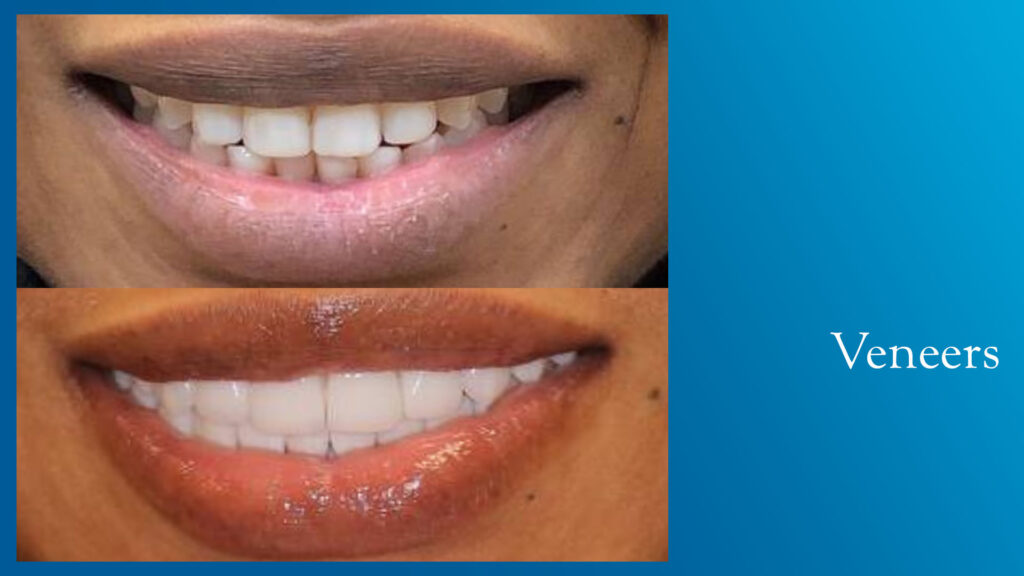 Yonge and Bloor Dental Care patient before & after