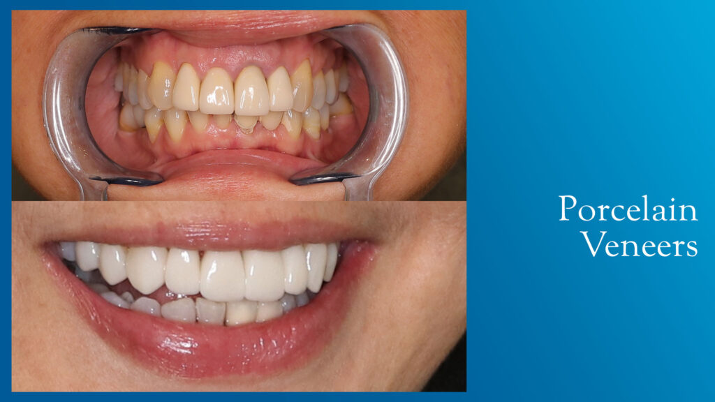 Yonge and Bloor Dental Care patient before & after