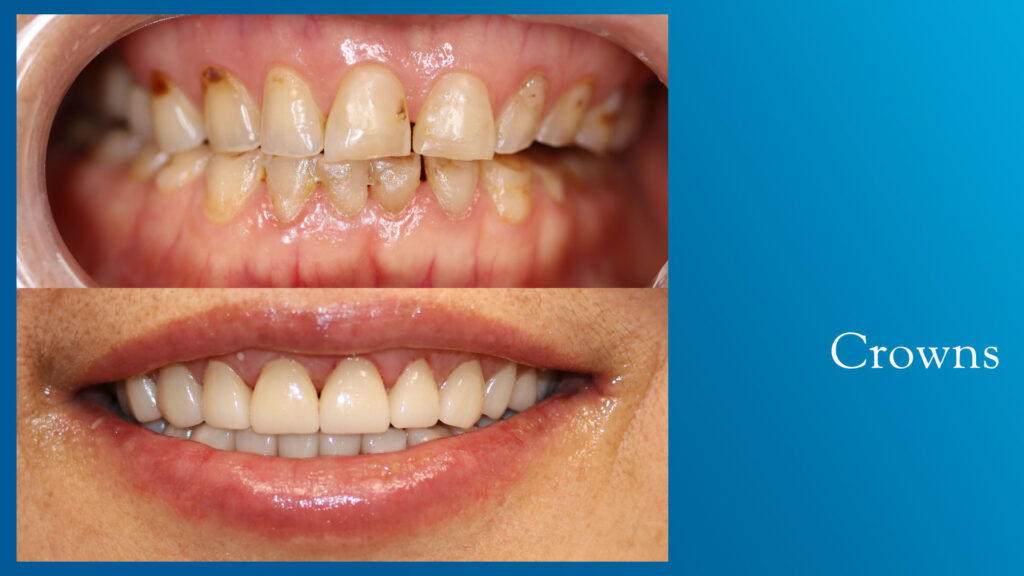 Yonge and Bloor Dental Care patient before & after