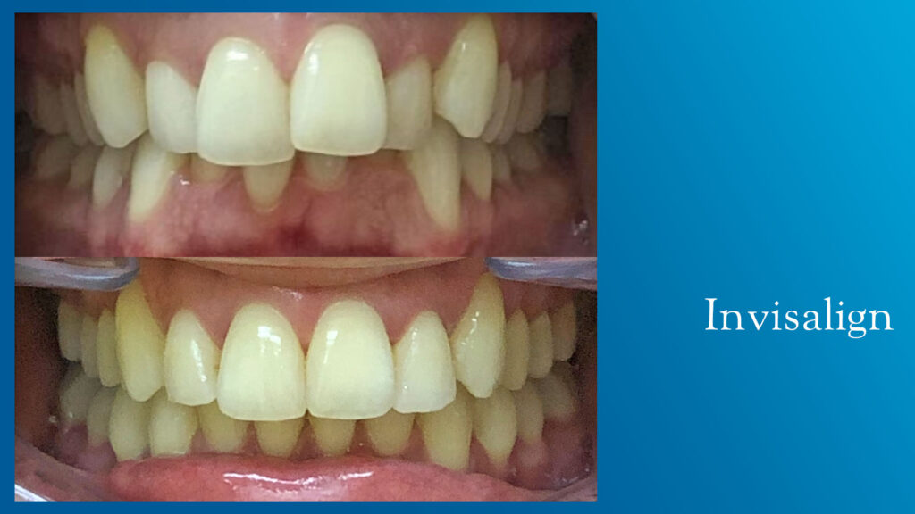 Yonge and Bloor Dental Care patient before & after