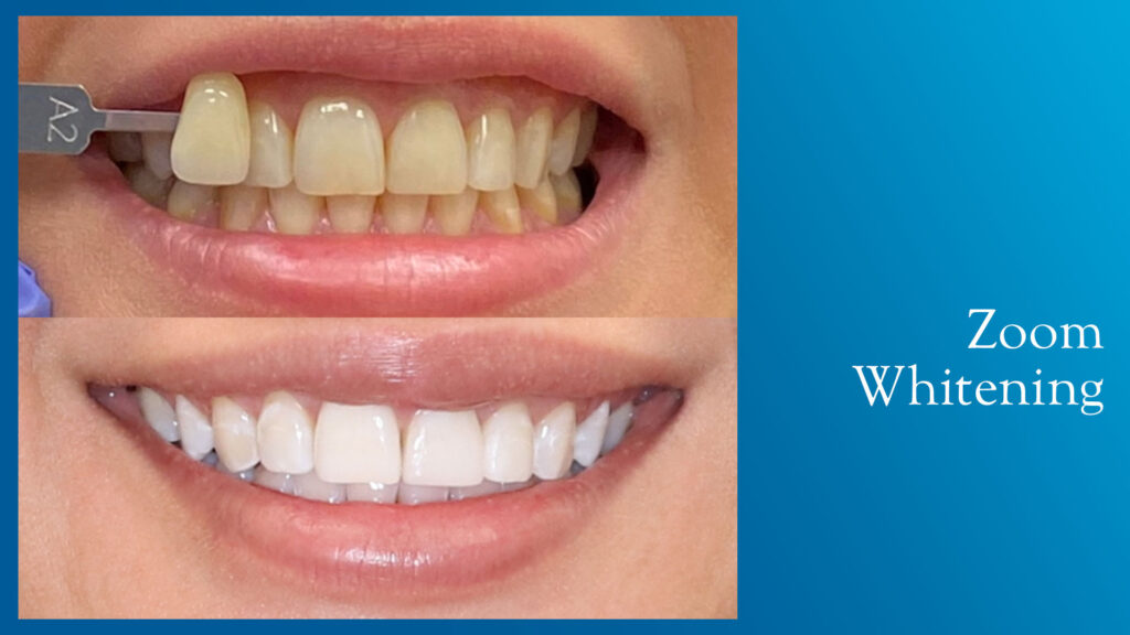 Yonge and Bloor Dental Care patient before & after