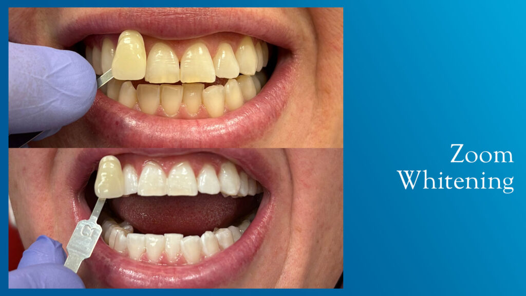 Yonge and Bloor Dental Care patient before & after
