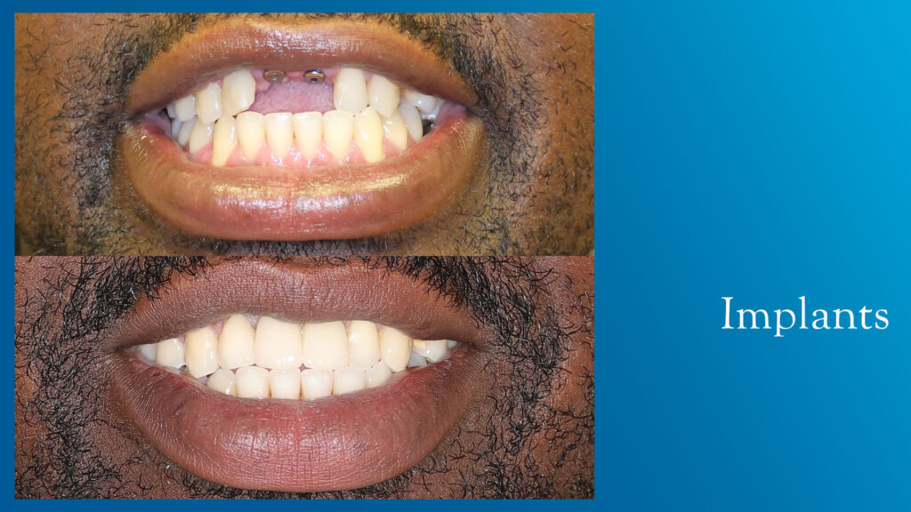 Yonge and Bloor Dental Care patient before & after