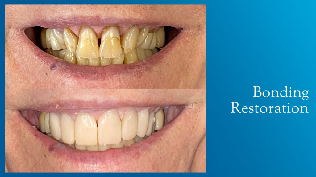 Yonge and Bloor Dental Care patient before & after