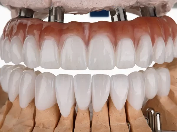 All-on-4 Dental Implants
