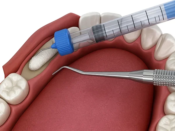 Bone Grafting