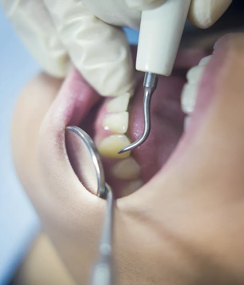 Bone Grafting