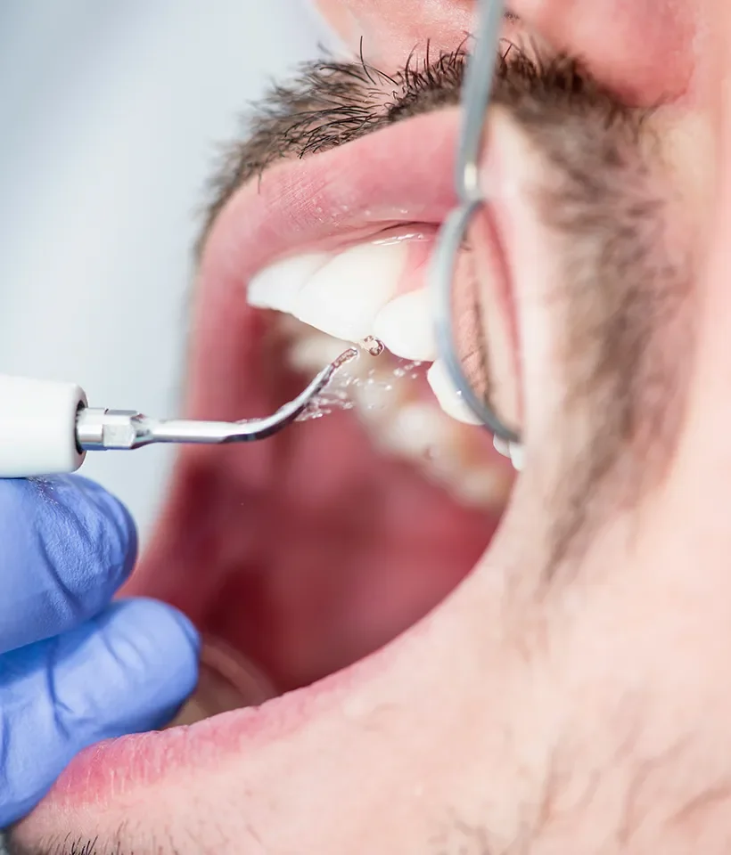 Crown Lengthening