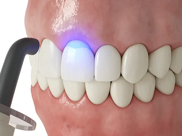 Dental Bonding