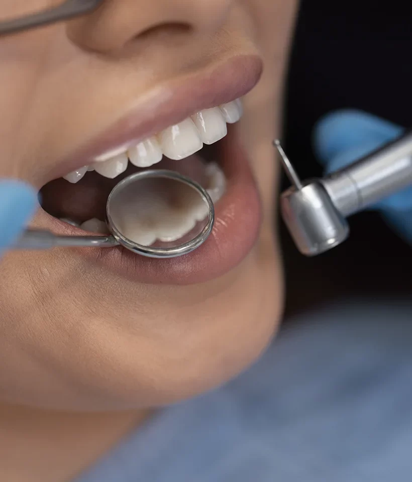 Dental Bonding