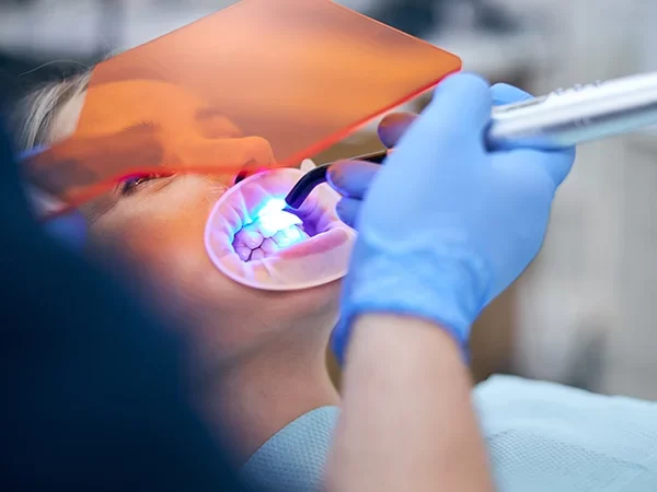 Direct Composite Bonding