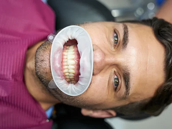 Adhesive Bonding (Indirect Restorations)