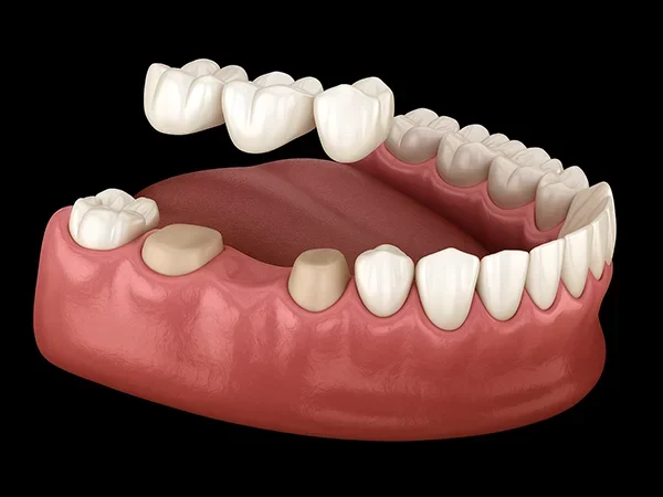 Dental Bridges