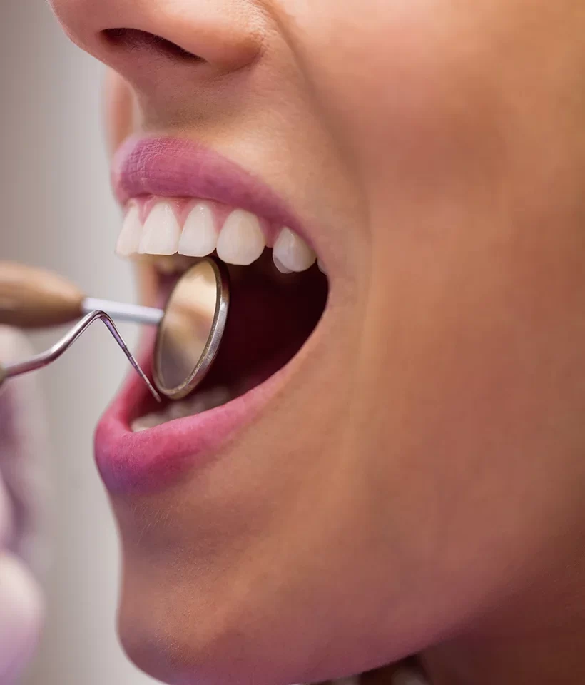 Dental Bridges