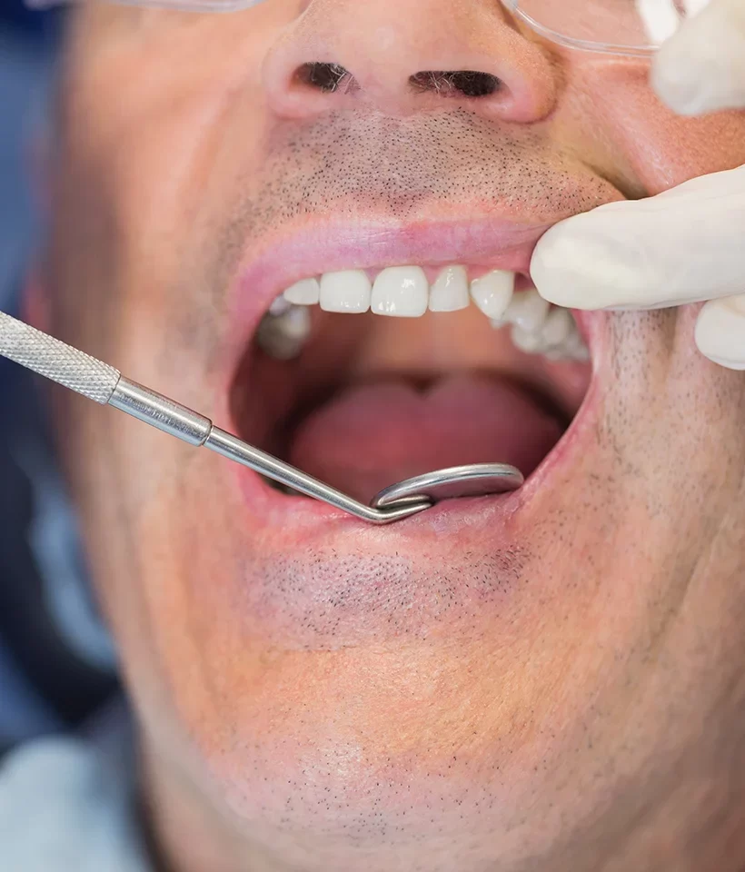 Dental Bridges