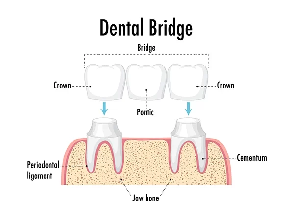 Traditional Dental Bridges