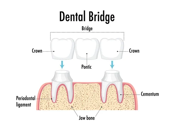 Traditional Dental Bridges