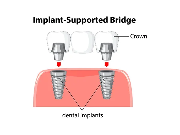 Implant-Supported Bridge