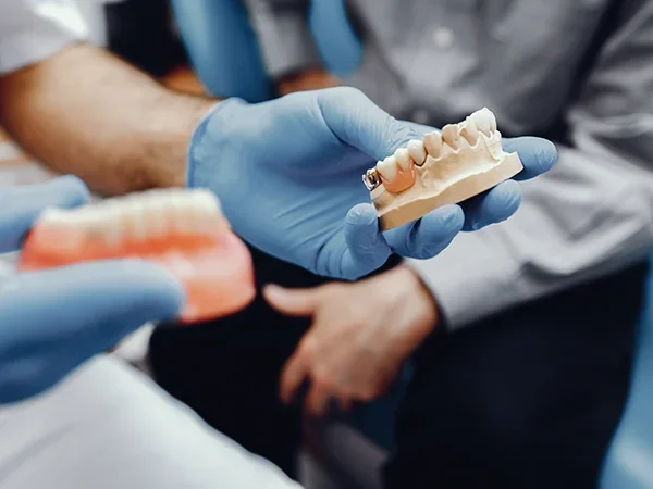 Cantilever Dental Bridges