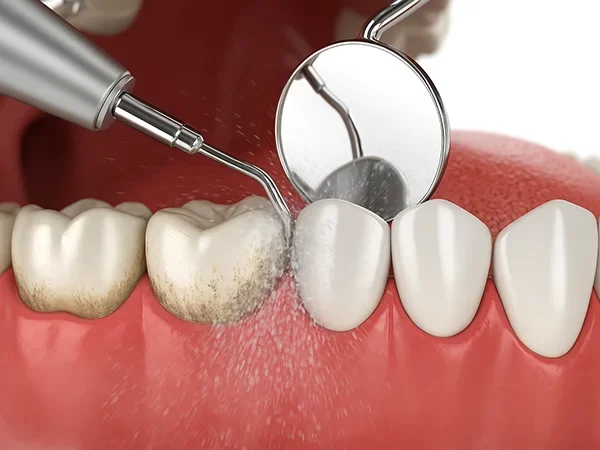 Dental Cleanings
