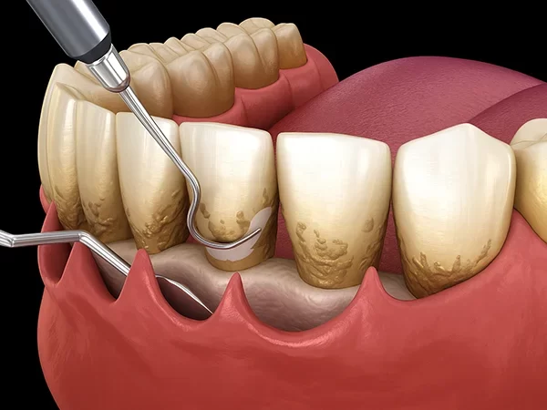 Deep Cleaning (Scaling and Root Planing)