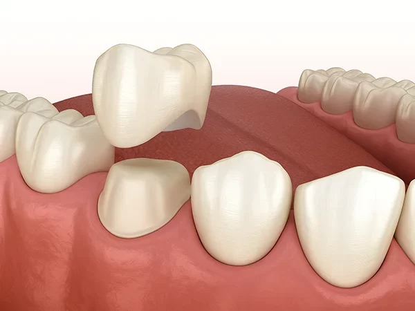 Dental Crowns