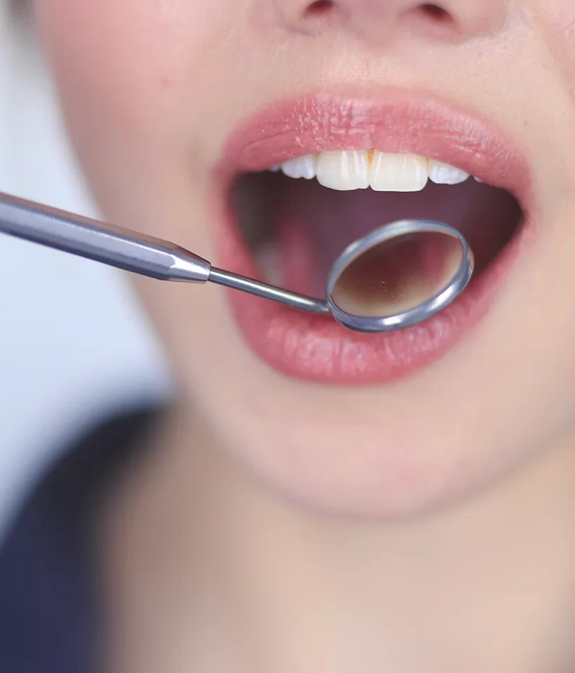 Dental Crowns