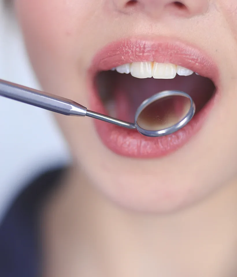Dental Crowns