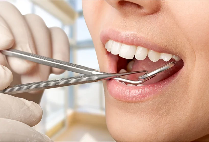 Dental Crowns