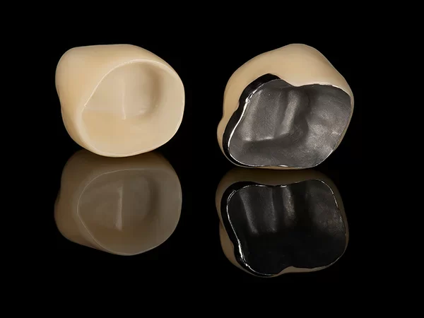 Porcelain-Fused-to-Metal Crowns