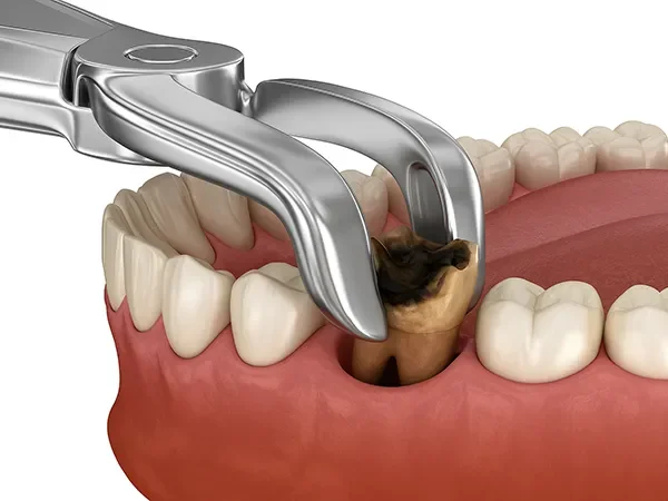 Dental Extractions