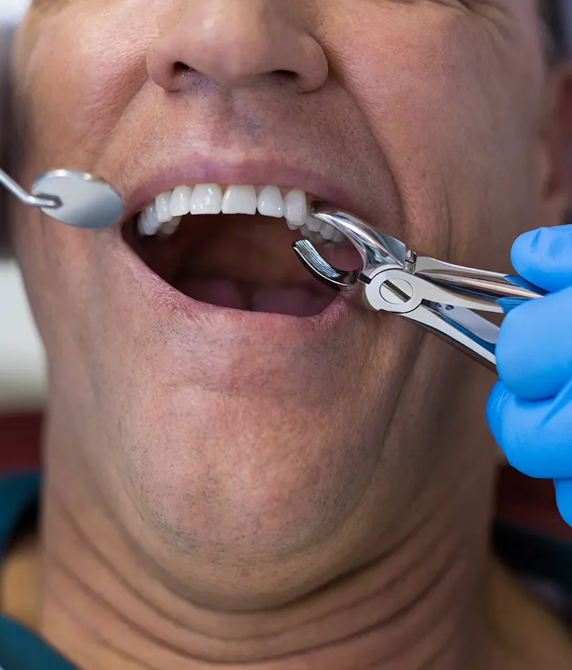 Dental Extractions