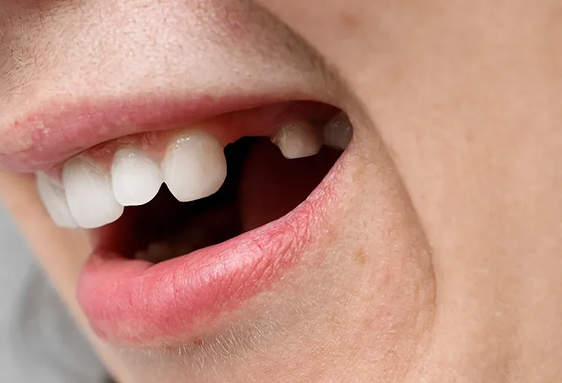 Dental Extractions