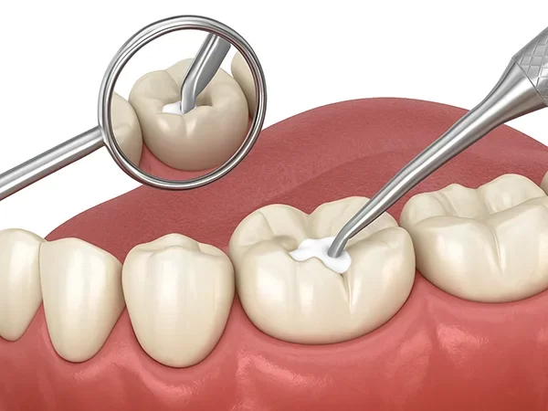 Dental Fillings