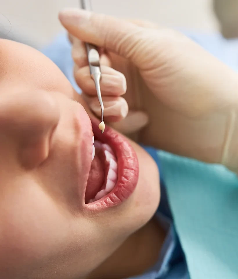 Dental Fillings