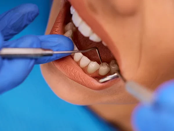 Composite (Tooth-Coloured) Fillings