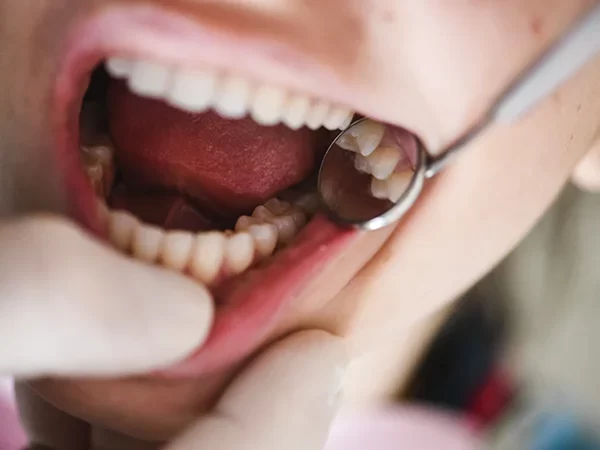 Amalgam Fillings (When Appropriate)