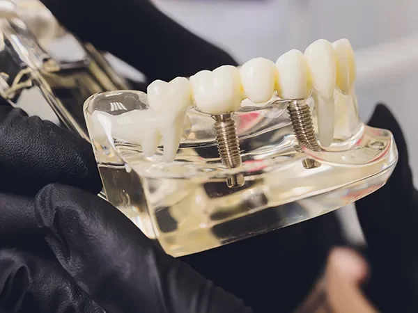 Implant-Supported Bridges