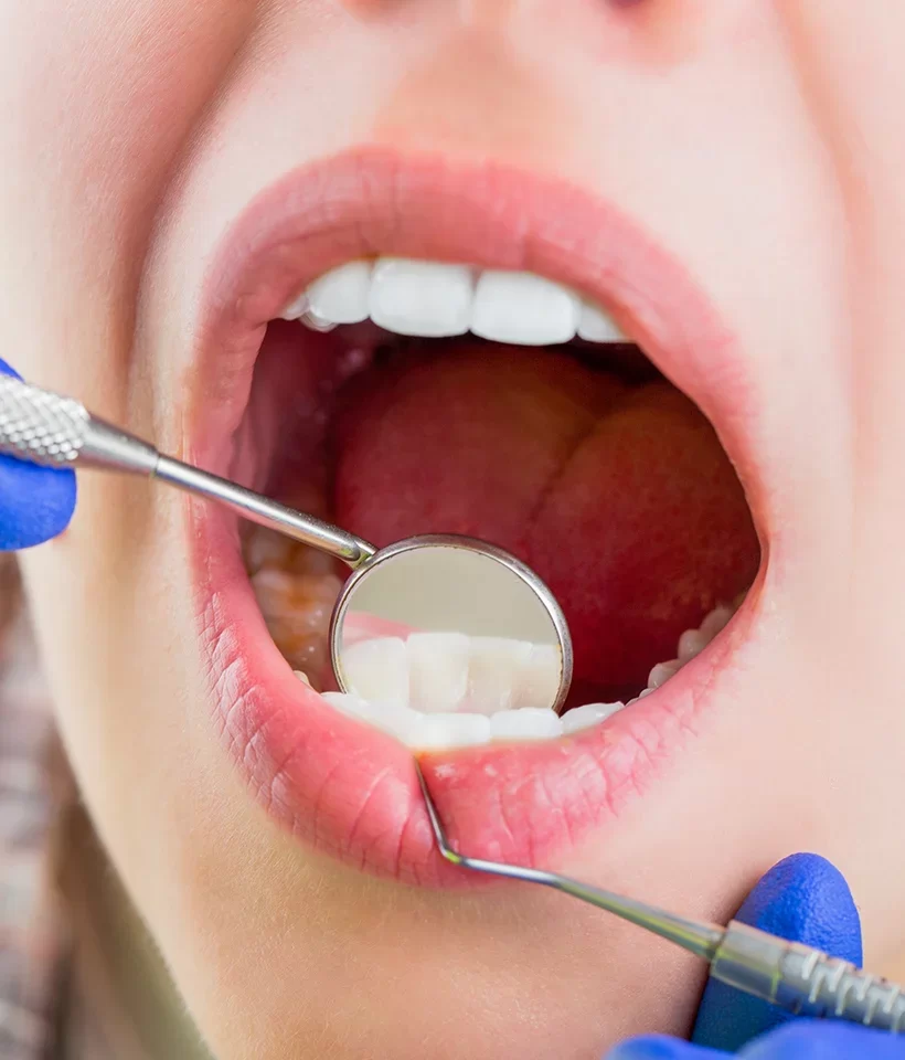 Dental Sealants