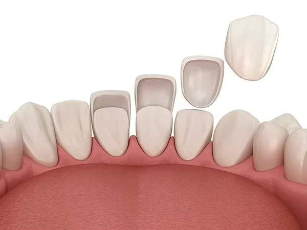 Dental Veneers