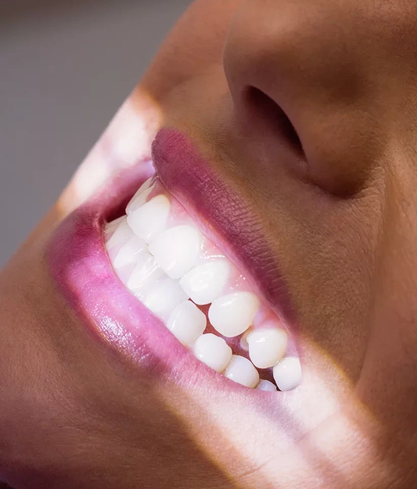 Dental Veneers
