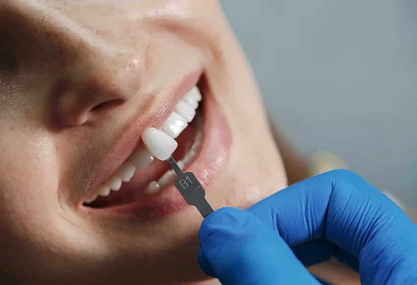 Dental Veneers