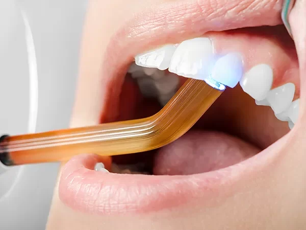 Fluoride Varnish